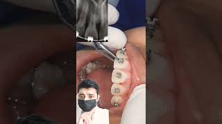 brackets ortodoncia dentista dientes [upl. by Basil595]