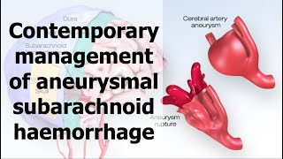 Contemporary management of aneurysmal subarachnoid haemorrhage [upl. by Nnauol445]