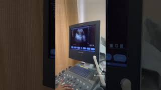 Antenatal scan low lying placenta dramnaraza infertility antenatal [upl. by Manthei]