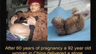 SYMPTOMS OF LITHOPEDION  STONE BABY II लिथोपैडिओन के लक्षण  पत्थर का बच्चा II [upl. by Jaquith]