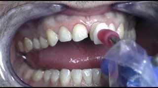 Prepless Veneers Procedure at Cosmetic Dental Associates San Antonio TX Dental Practice [upl. by Godric]