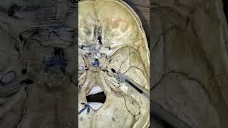 middle cranial fossa spotting easy explanation [upl. by Asilahs]