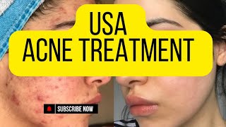 Top Acne Treatment Tips for Clear SkinUnited States Acne Treatment [upl. by Tankoos385]