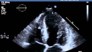 Transthoracic Echocardiographic Images Obtained after Cardiac Catheterization [upl. by Crescin70]