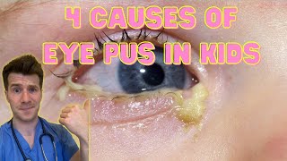 Doctor explains 4 causes of eye pus discharge or sticky eyes in kids  Doctor ODonovan [upl. by Rashida741]