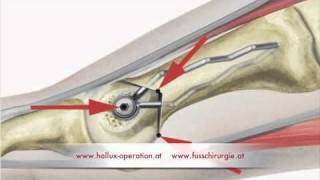 Hallux Operation nach Stoffella Teil 23 Osteotomie [upl. by Erbua374]