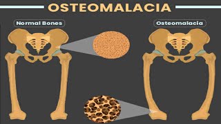 OSTEOMALACIA [upl. by Ger]