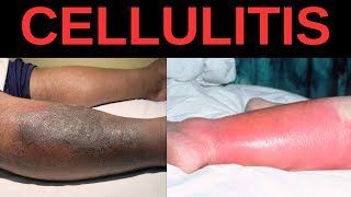 What is Cellulitis Symptoms Causes Treatment [upl. by Haig]