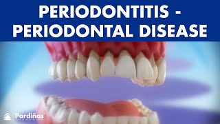 Gum disease  Periodontitis  Periodontal Disease © [upl. by Neb759]