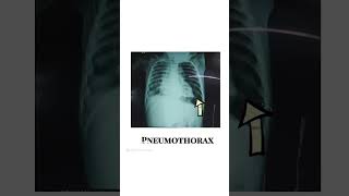 Pneumothorax empyema  water seal chest drainage system  youtubeshortspediatriciansshorts [upl. by Eirallam]