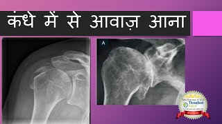 कंधे में से आवाज़ आना Noise Coming from Shoulder Hindi [upl. by Aseneg993]