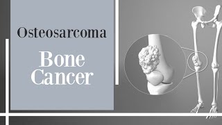 bone cancer  Osteosarcoma [upl. by Llehsyt]