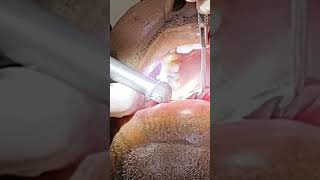 maxillary premolar rctroot canalpart 1 [upl. by Inaflahk]