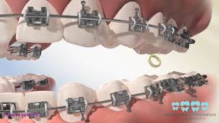 Posterior Crossbite Elastics [upl. by Edholm]