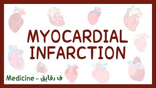 Myocardial infarction  definition causes symptoms investigations amp treatment عربي [upl. by Acissaj]