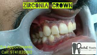 zirconia crown metal free crowns  smile designing [upl. by Wernher97]