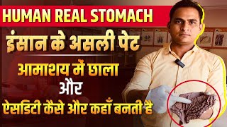 FullVideoAcidity amp Gastric Ulcer in Real Stomach  इंसान के असली पेट में ऐसिडिटी और छाले viral [upl. by Einwahs]