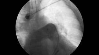 Pulmonary embolus [upl. by Loos]