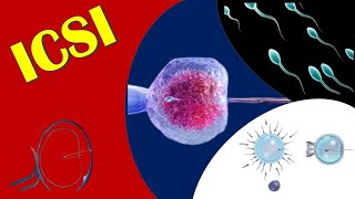 ICSI  Intracytoplasmic Sperm Injection [upl. by Ravaj]