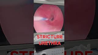 How stricture urethra look urethralstricturetreatment urethralstricture strictureurethra [upl. by Plantagenet]