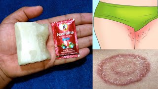 जाँघो के बीच की दाद खाज खुजली की मात्र 3 दिनों में छुट्टी कर देगा  ringworm treatment  daad khaj [upl. by Eat578]