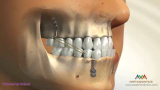 Orthodontic Treatment for Underbite or Crossbite  Bone Anchored Maxillary Protraction [upl. by Millur]