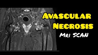 Avascular necrosis  Osteonecrosis  MRI HIP JOINT  Radiology [upl. by Danuloff]