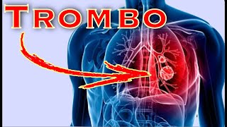 Trombo Embolismo Pulmonar [upl. by Attenrev]