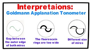 Interpretations Goldmann Applanation Tonometer [upl. by Lashond]