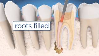 Root Canal Retreatment Explained [upl. by Aytak]