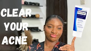 HOW TO CLEAR YOUR SKIN WITH BENZOYL PEROXIDE  PANOXYL ACNE FOAMING WASH 10 REVIEW [upl. by Aserat]