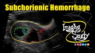 Subchorionic Hemorrhage  Ultrasound  Case 258 [upl. by Merrielle]