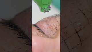 A single solution to reduce wrinkles around the eyes Avignon Thermage FLX for Eyelids and Eyes [upl. by Gardener]