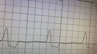 Electrocardiogram ECG or EKG 140 days after a leadless pacemaker implantation [upl. by Nylrac]