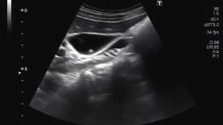 Ultrasound Video showing a polyp and sludge ball in Gall bladder with hepatic mass [upl. by Hamann768]