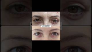 Üst Göz Kapağı Ameliyatı Upper Eyelid Surgery [upl. by Orsino461]