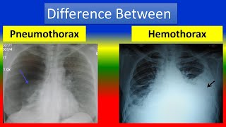 Difference between Pneumothorax and Hemothorax [upl. by Berlin]