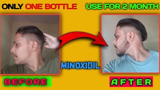 MINOXIDIL Beard Growth Journey  How to Grow Beard fast  Minoxidil Beard Transformation of 2 Months [upl. by Nortal]