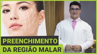 Harmonização Facial através do Preenchimento da Região Malar com Ácido Hialurônico acidohialuronico [upl. by Aikaz]