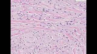 Histopathology SkinGranular cell tumor [upl. by Henderson]