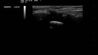 Ultrasonido de articulación acromioclavicular con luxación asociada a desgarro del supraespinoso [upl. by Leroy]