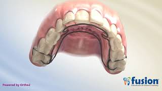 Crozat Appliance Upper Removable Orthodontic Expander [upl. by Ytsur401]