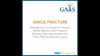 Ankle Fracture  Management Technique for Fracture Medial Malleolus with Posterior Malleolus [upl. by Harutak]