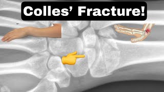 Colles’ Fracture facts shorts collesfracture [upl. by Zitvaa]