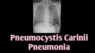 Pneumocystis Carinii Pneumonia  PCP  Pneumocystis Jirovecii [upl. by Eentruoc]