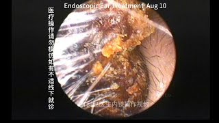 Removal of severely blocked earwax embolism [upl. by Eyanaj]