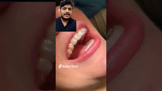 Fixed retainers after orthodontic treatment trending hospital dentalschoollife viralvideo [upl. by Adnalro]