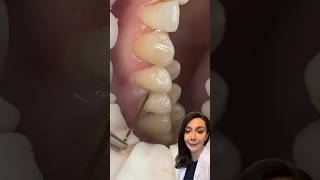 Why Do Dentists Place This Thread On The Gum [upl. by Ashelman]