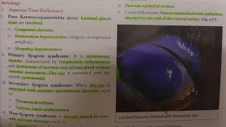 Keratoconjunctivitis Sicca  EYE [upl. by Etnohc859]