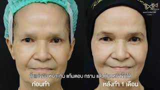 Sculptra VS Radiesse ต่างกันอย่างไร [upl. by Yelime611]